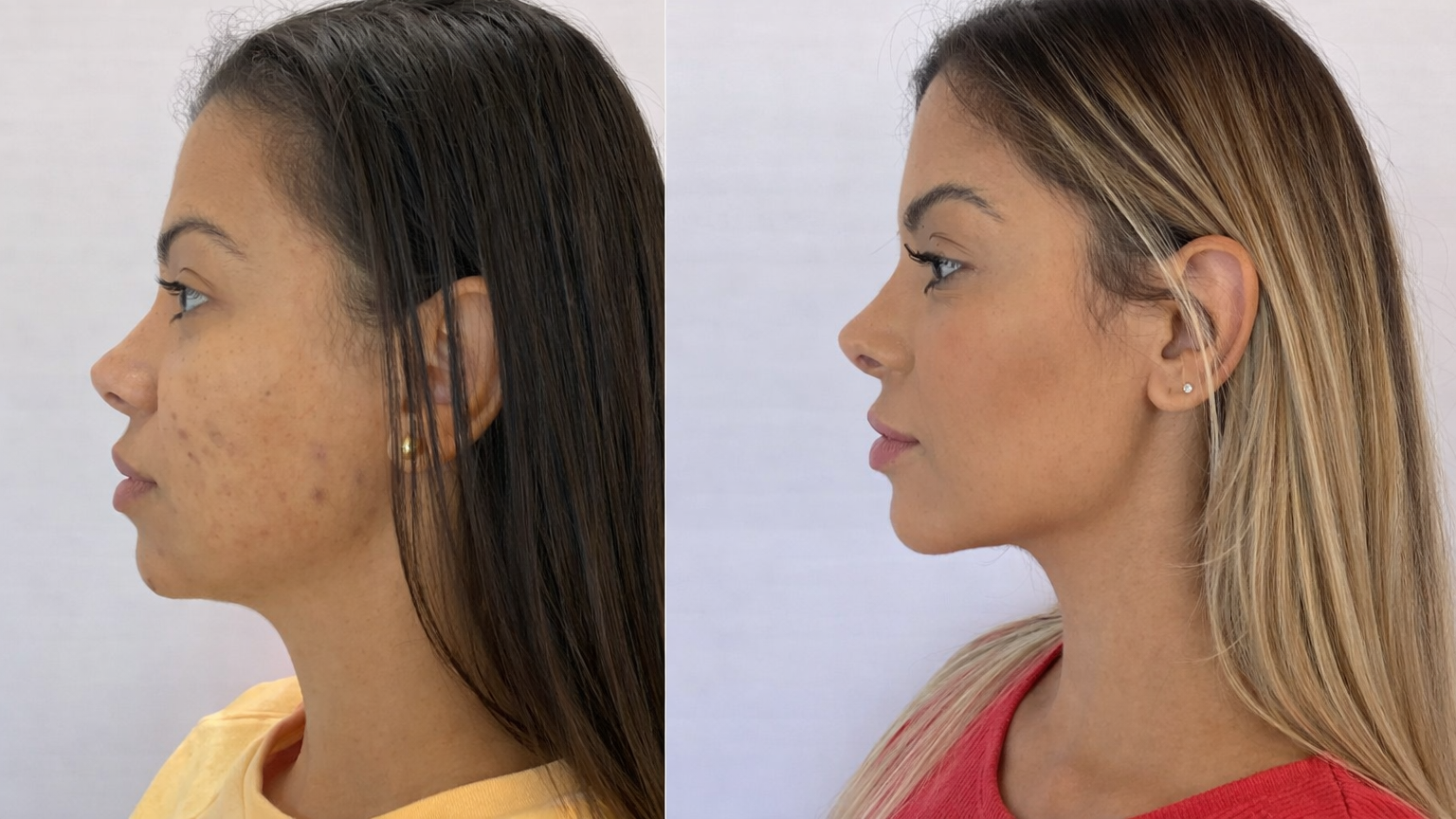 Resultado Harmonização Facial